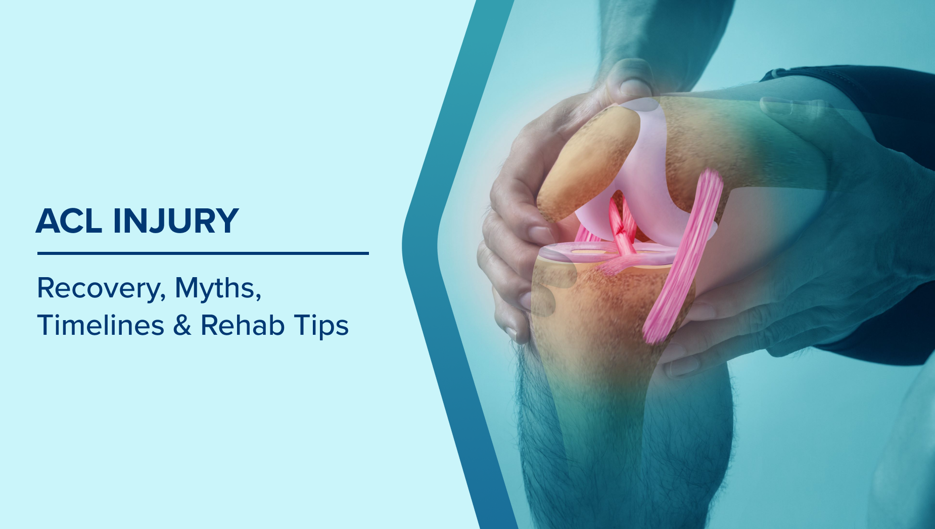 ACL Tear Surgery: Myths, Facts, Recovery & Complete Guide