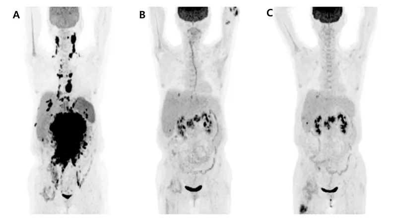 Terapia CAR-T, il sistema immunitario diventa un'arma contro alcuni tumori