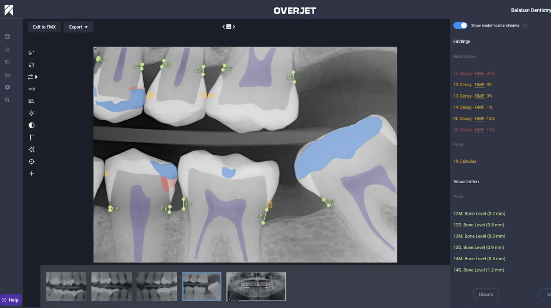 Overjet Vision AI analyzing dental x-ray