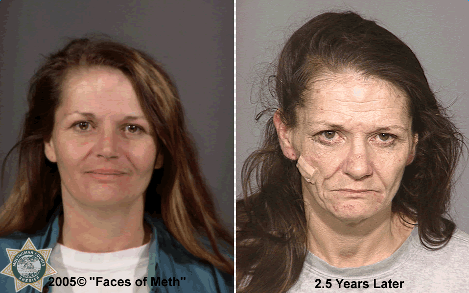 image showing subtle physical signs of meth use like skin sores or dental issues - crystal meth rehab
