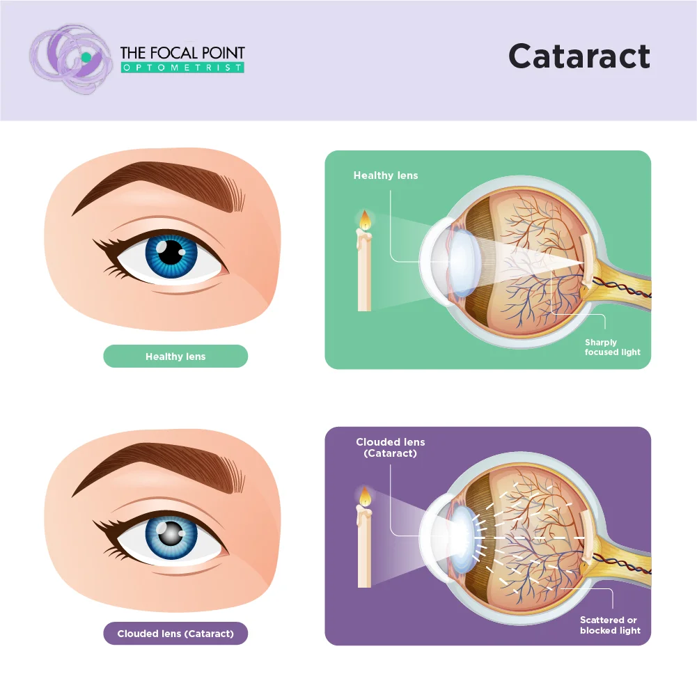 Infographic comparing a healthy eye lens and a cloudy lens affected by cataracts, showing the clear, transparent lens versus the opaque, blurred lens that impairs vision.