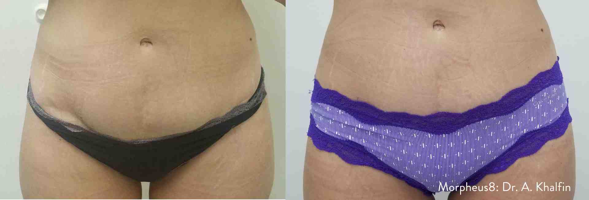 before-and-after comparison of a stomach treated with Morpheus8 - morpheus8 skin tightening stomach