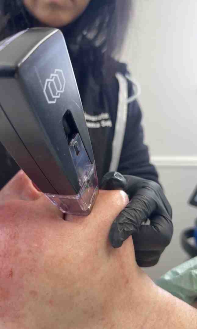 Morpheus8 device being used on a patient's lower face/jawline - microneedling near me