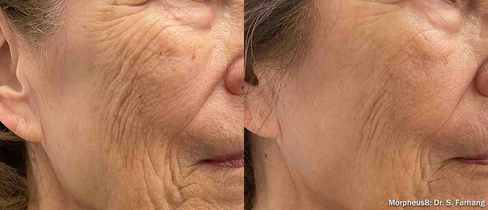 Collage showing before-and-after photos for jowls, acne scars, and neck lines - morpheus skin treatment