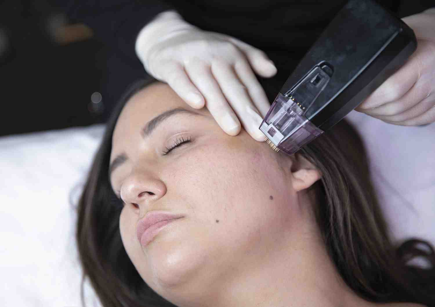 a patient relaxing comfortably during a numbing cream application - morpheus skin treatment price