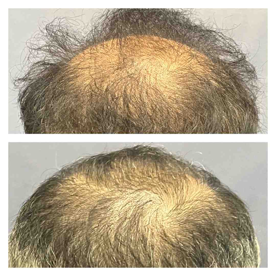 A dermatologist using a dermatoscope to examine a patient's scalp - bald spot