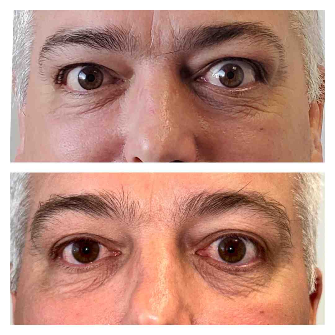 Before and after eyelid surgery - ted eye disease
