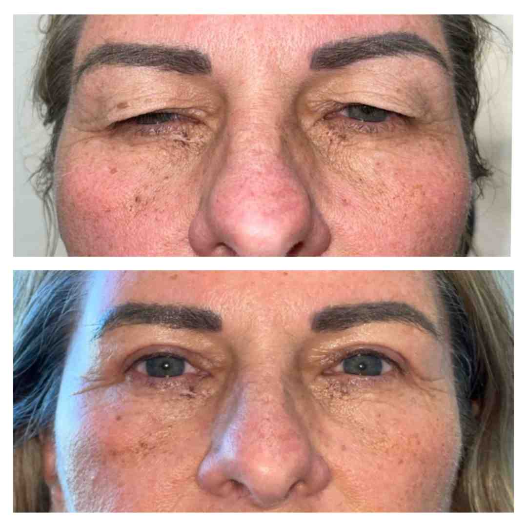 showing the difference between a normal eyelid and one with ptosis - eyelid problems