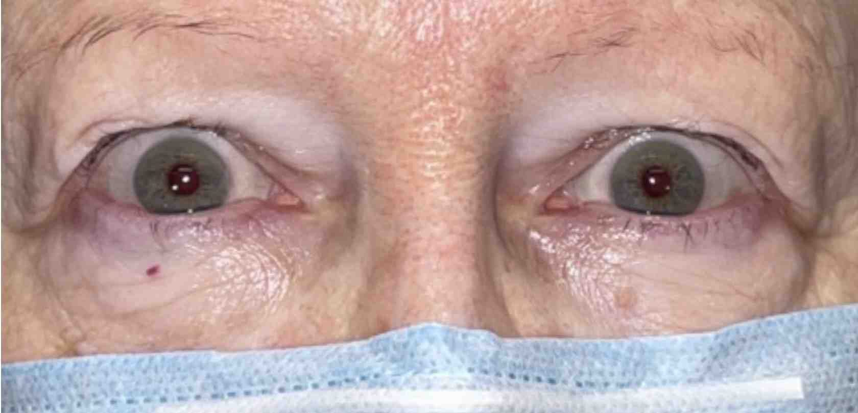 A person with bulging eyes due to thyroid eye disease - overactive thyroid symptoms