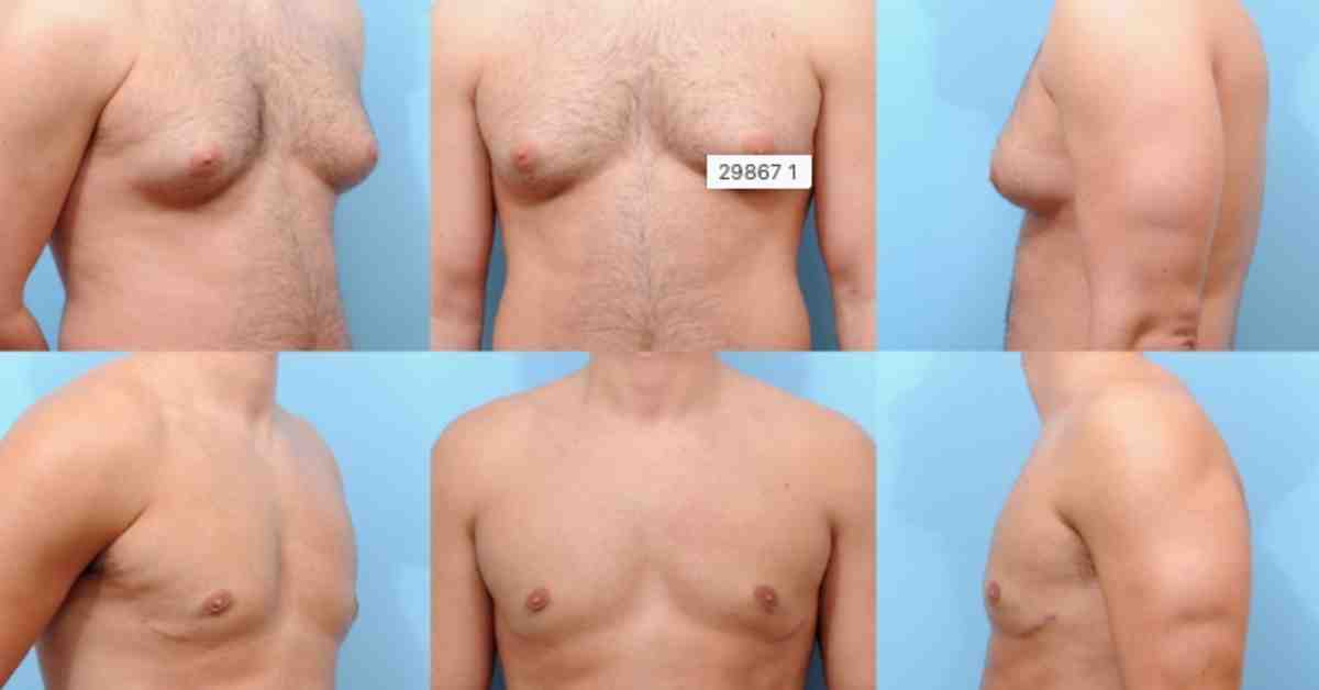 Gynecomastia patient's before and after photos, showing frontal view transformation - gynecomastia surgery before and after pics