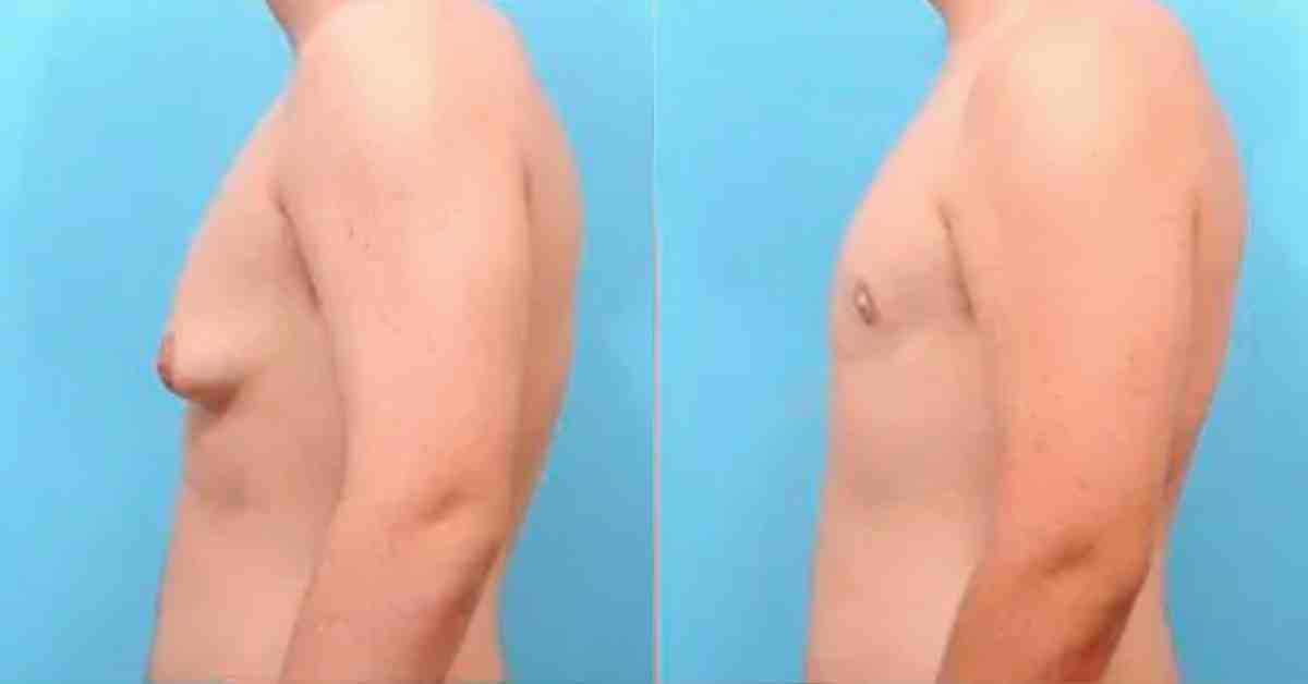 Gynecomastia patient's before and after photos, showing side profile view transformation - gynecomastia surgery before and after pics