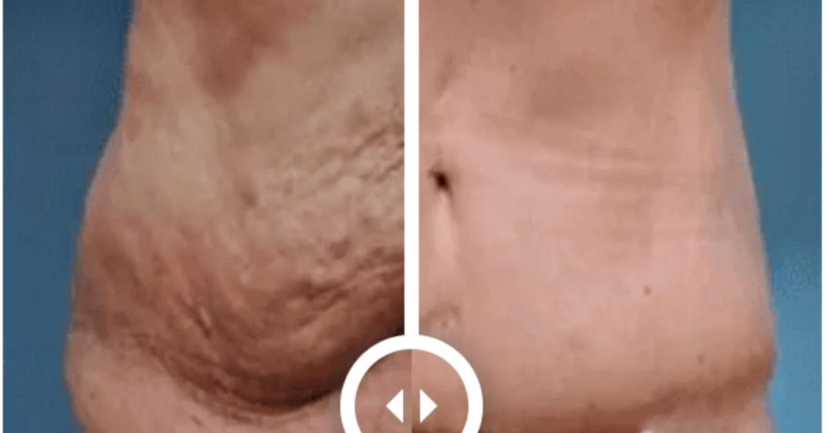 tummy tuck before and after comparison from the front - tummy tuck before and after