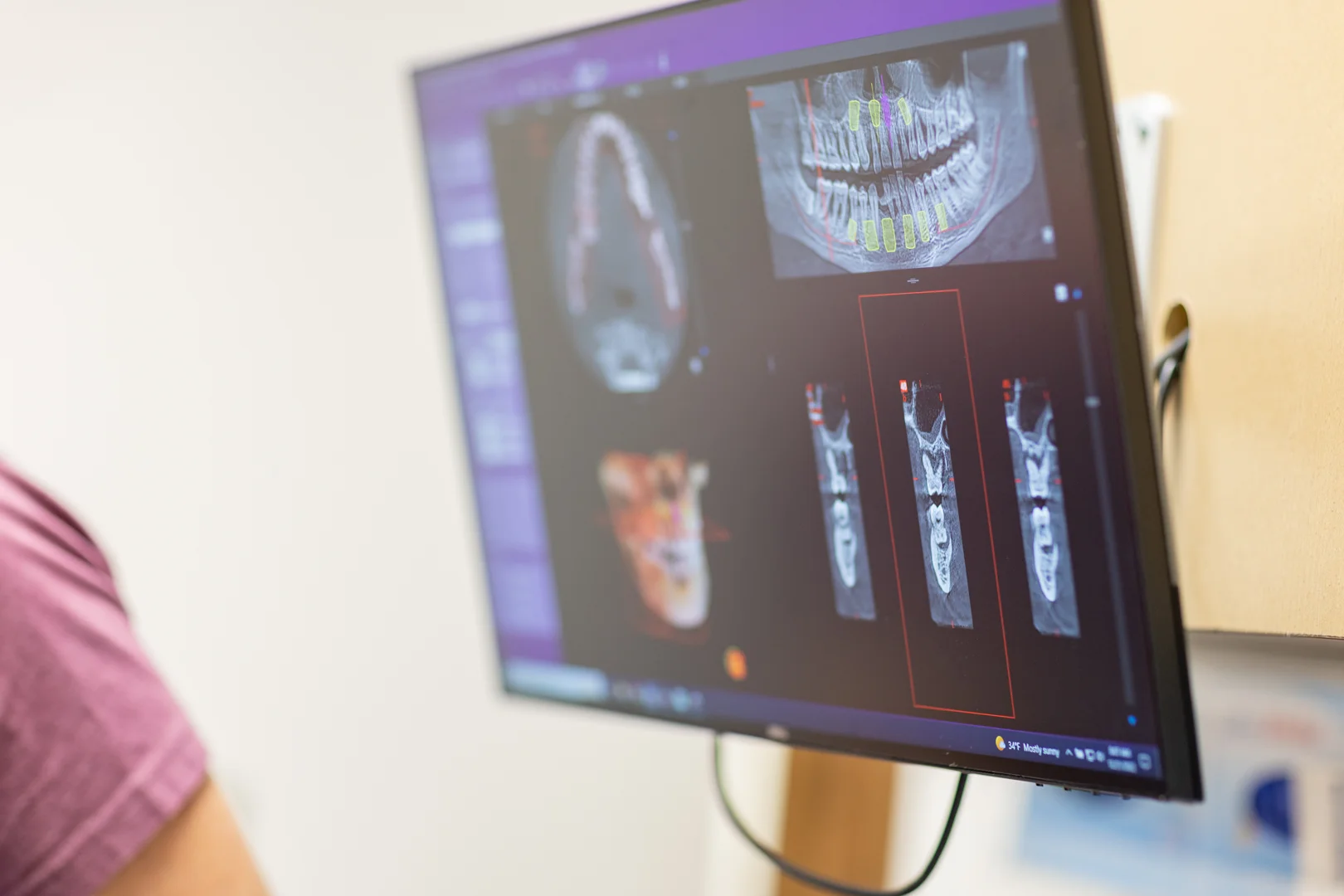 Digital smile design software on screen at Just Wright Dental and Implant Center in Corsicana, TX, planning a denture smile