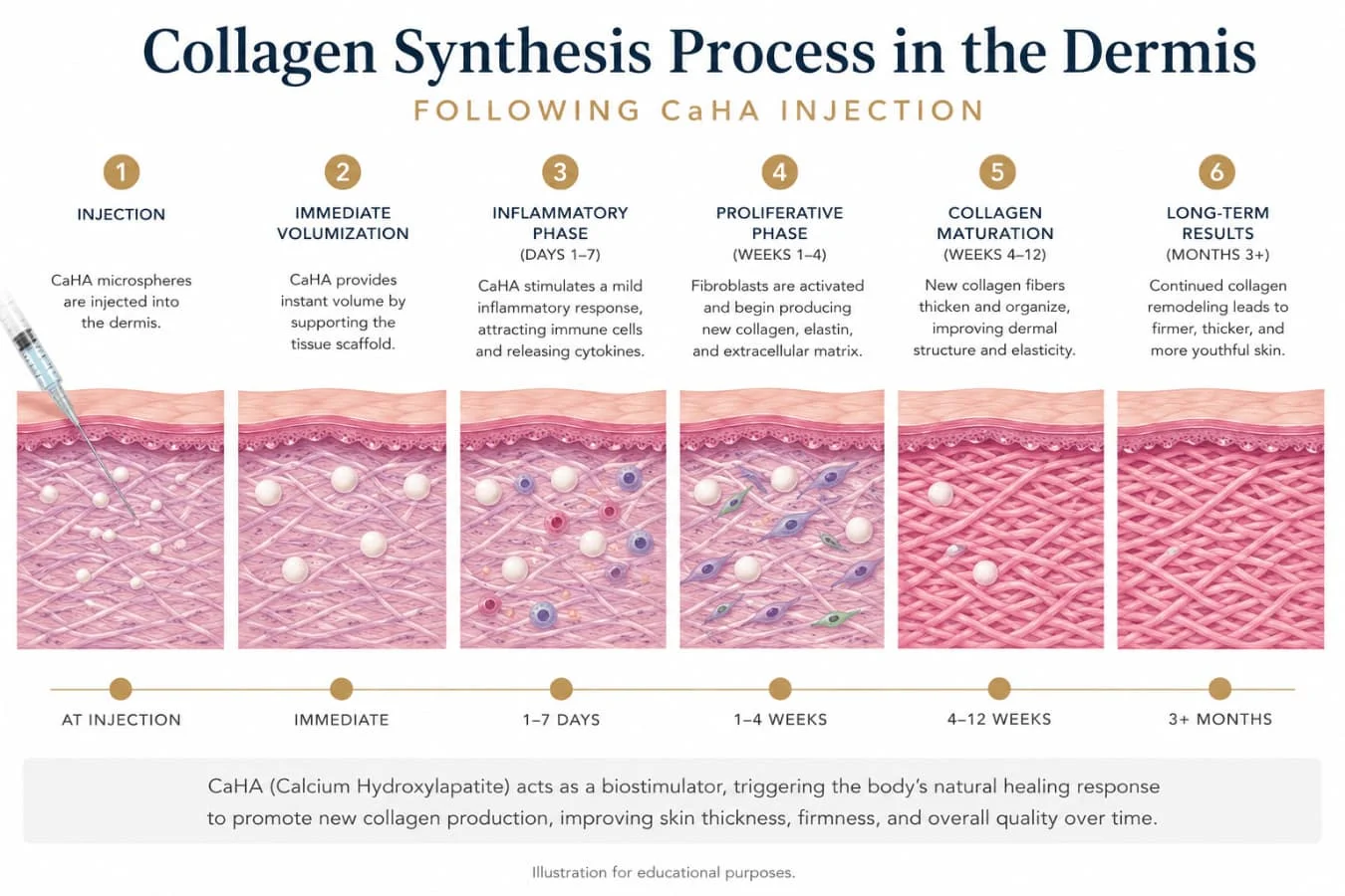 Collagen Synthesis Process In The Dermis Following Caha Injection