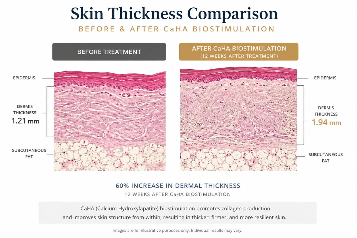 Skin Thickness Comparison Before And After Caha Biostimulation