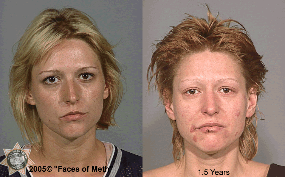 before/after mugshot showing rapid aging and severe skin sores from meth use - people before and after drugs