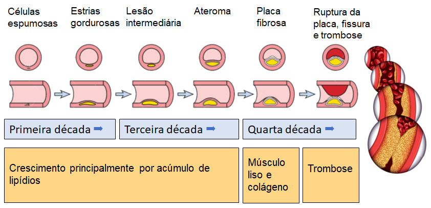 Desenvolvimento da placa aterosclerótica.