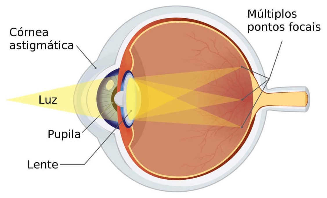 Astigmatismo.