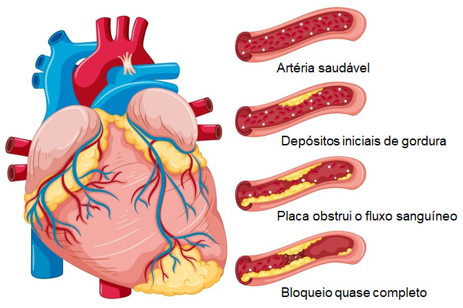 Doença arterial coronariana (DAC).
