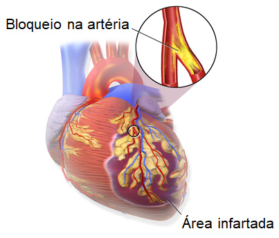 Aterosclerose e infarto do miocárdio (IM).