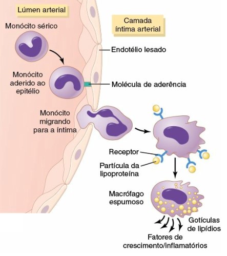 Aterosclerose: formação de células espumosas.