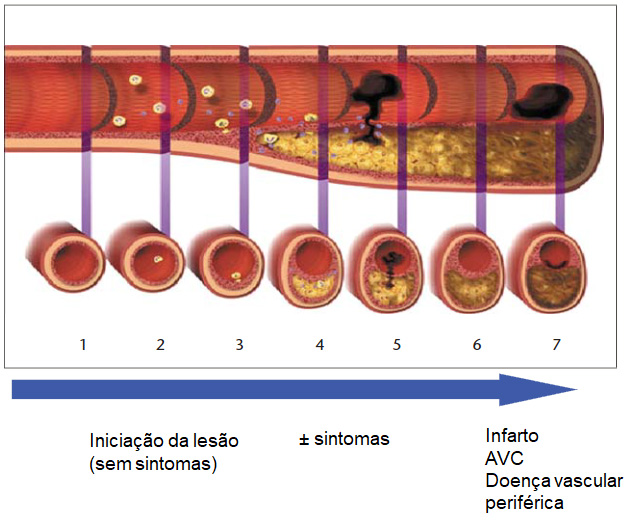 As diferentes fases de desenvolvimento da placa aterosclerótica. 