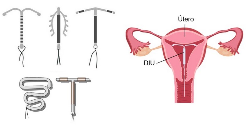 DIU: tipos e posicionamento no útero.