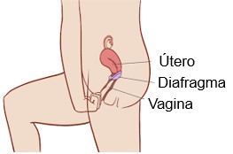 Diafragma posicionado no interior da vagina.