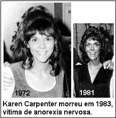 Anorexia nervosa: Karen Carpenter.