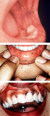 Doença de Addison: pigmentação anormal em áreas da mucosa oral.