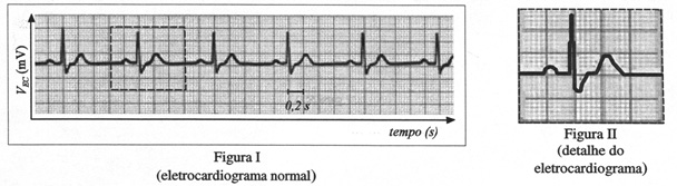ECG normal (2° vestibular UnB/DF 2001).