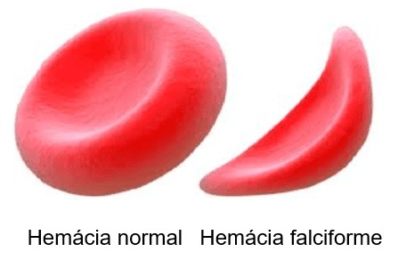 Hemácia normal e hemácia falciforme.