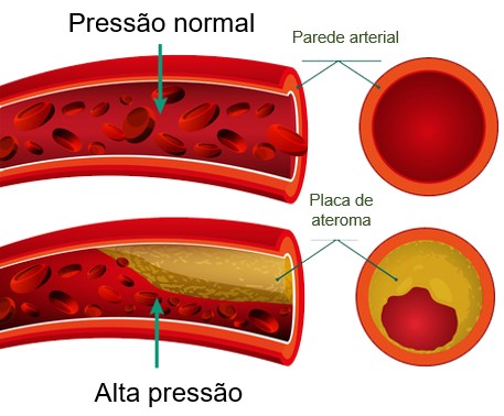 Aterosclerose e hipertensão arterial (HA).