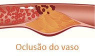 Bloqueio do fluxo de sangue.