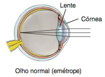 Olho normal (emétrope).