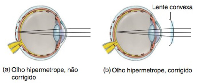 Olho hipermetrope não corrigido e corrigido.