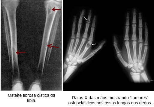 Osteíte fibrosa cística.