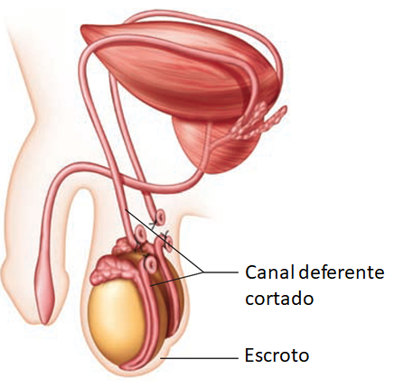 Vasectomia.