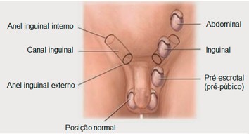Criptorquidismo.