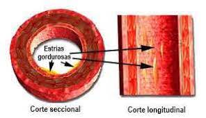 Estrias gordurosas.