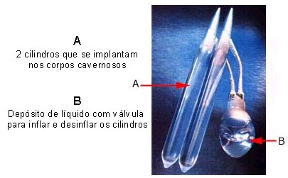 Prótese peniana inflável ou hidráulica.