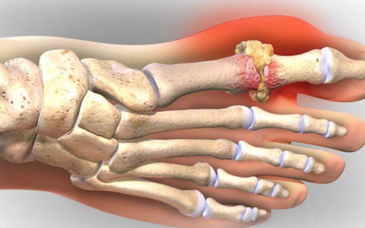 Chữa bênh gout hiệu quả 