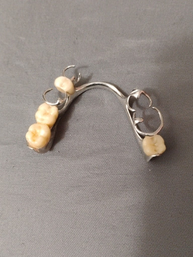 Metal partial denture framework with precision attachments and porcelain teeth