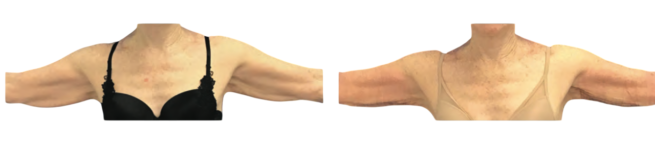 Before and after photos of a Renuvion procedure on the arms.