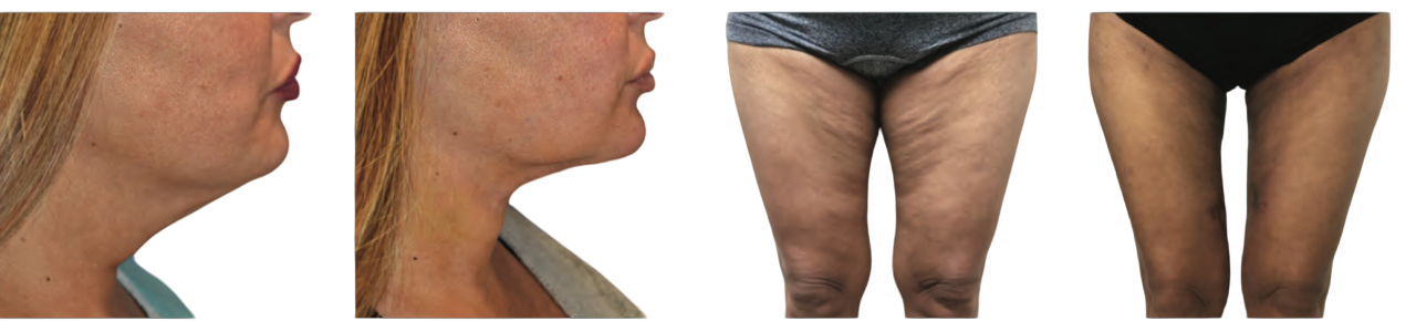Before and after photos of Renuvion procedures on the neck and thighs.