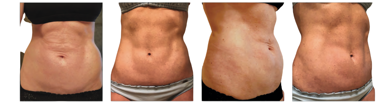 Before and after photos of a Renuvion procedure on the abdomen.