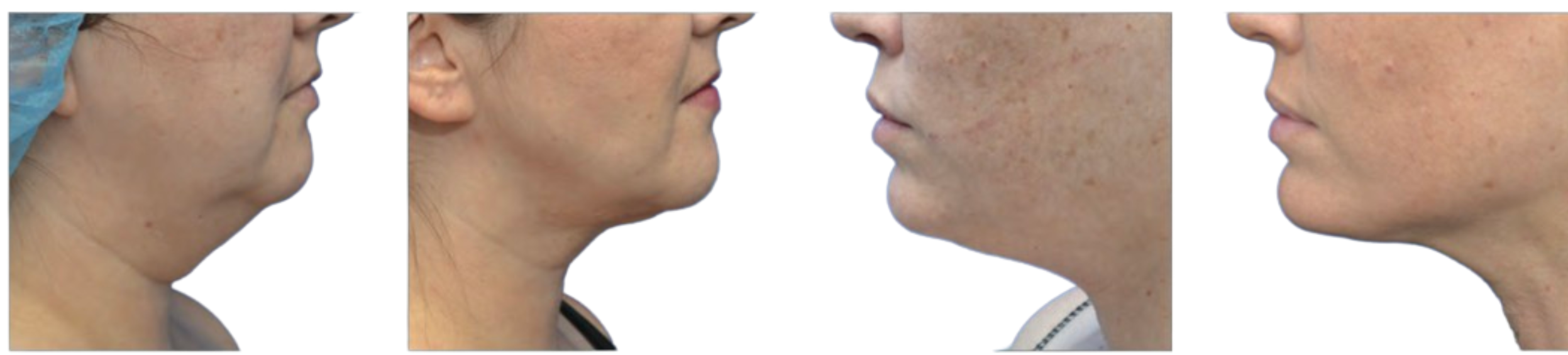 Before and after photos of Renuvion procedures on the neck and jowls.