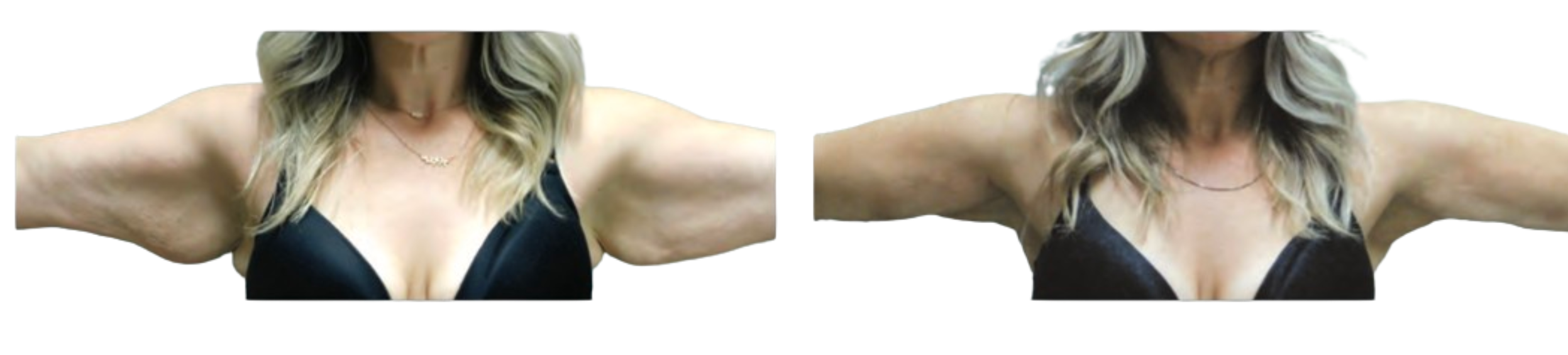 Before and after photos of a Renuvion procedure on the arms post-bariatric surgery.
