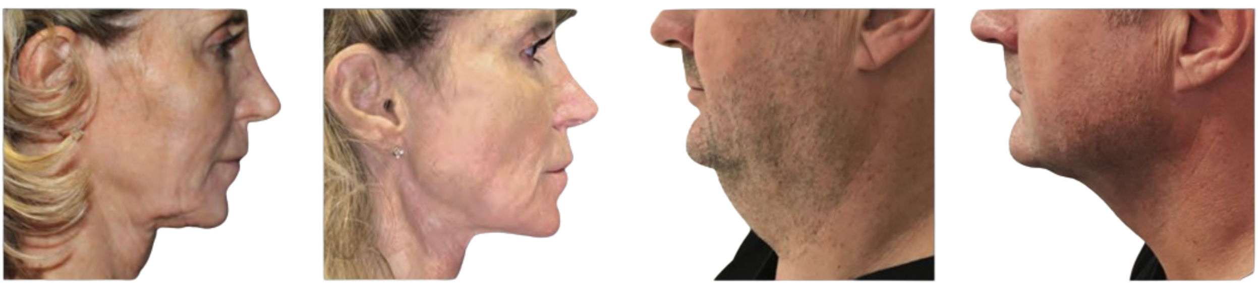 Renuvion J-Plasma device on a stand.