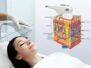 HIFU - ULTRASONIDO FOCALIZAFO ALTA INTENSIDAD